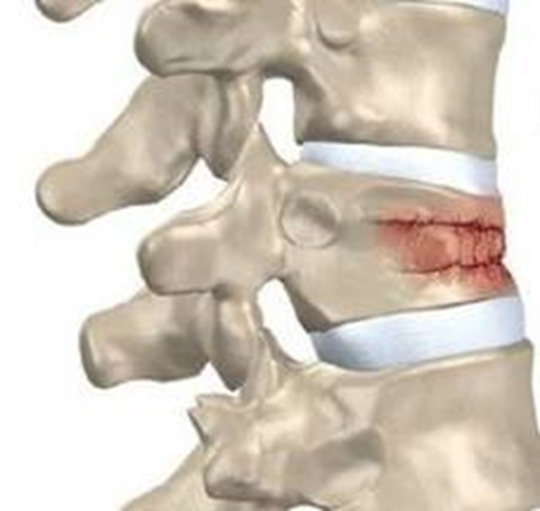 Osteoporosis: Faktor risiko, Fraktur Kompresi Vertebral dan Pencegahannya